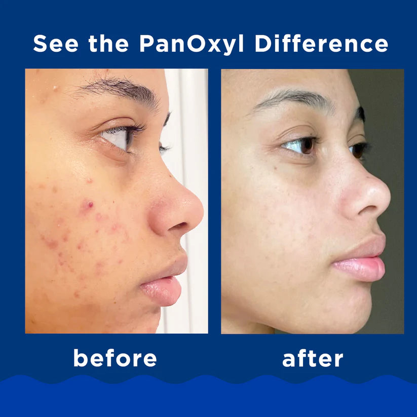 PanOxyl Acne Foaming Wash Benzoyl Peroxide 10% Maximum Strength 150g